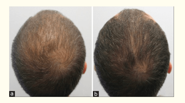 La mesoterapia con Dutasterida: Una ayuda más a la Alopecia.