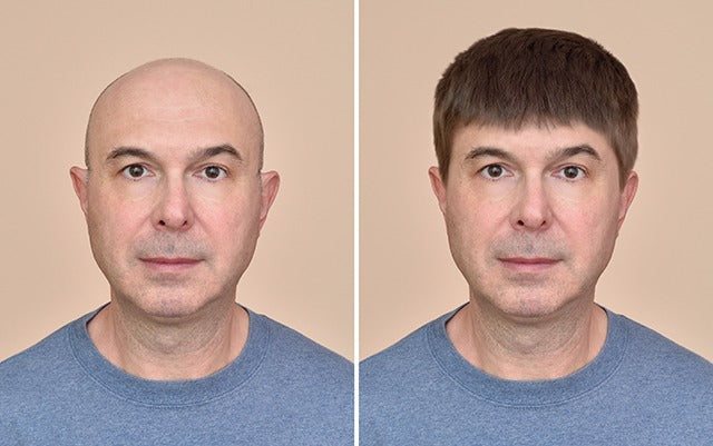 ¿Se recomienda Vipelin tras un implante capilar? ¿El pelo transplantado es para siempre?
