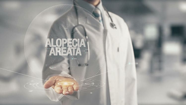 Alopecia Areata posible cura