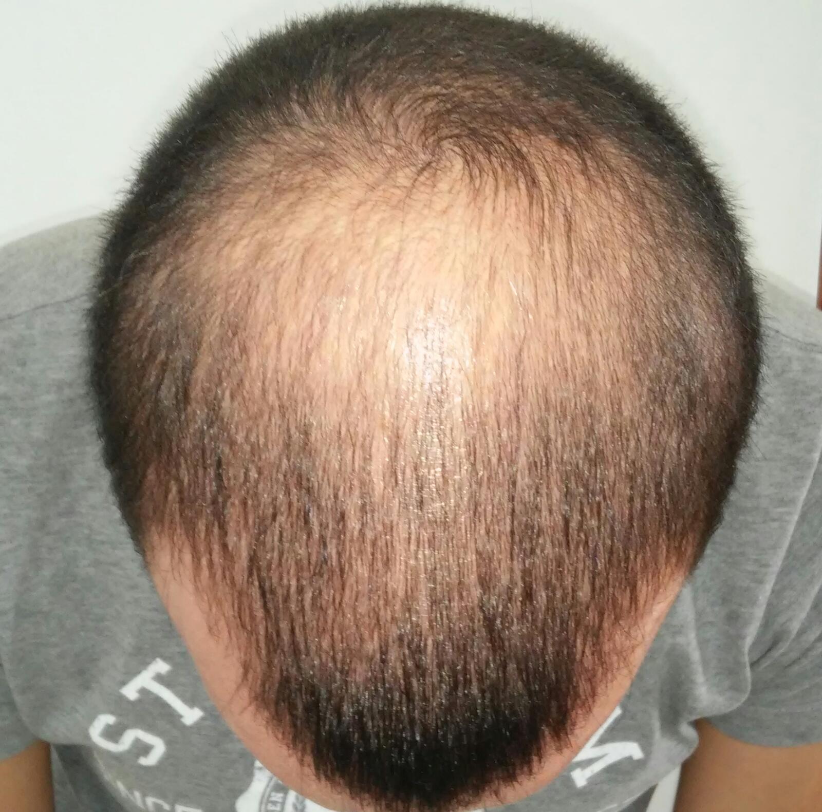 Antes