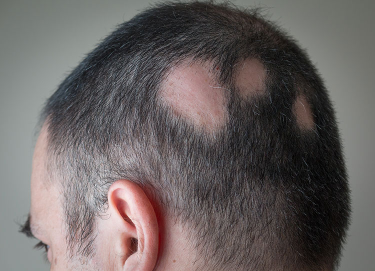 Alopecia Areata posible cura