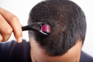 Usar un dermaroller con la loción Vipelín mejora el cuidado del pelo